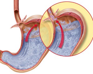 acid-reflux